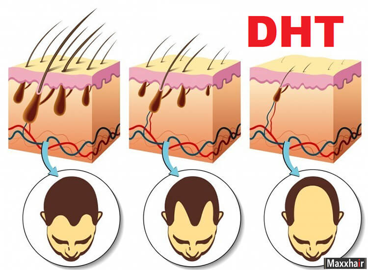 DHT là tác nhân chủ yếu gây rụng tóc