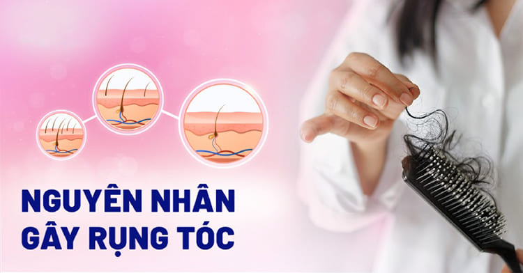 Các nguyên nhân gây ra tình trạng rụng tóc sau sinh