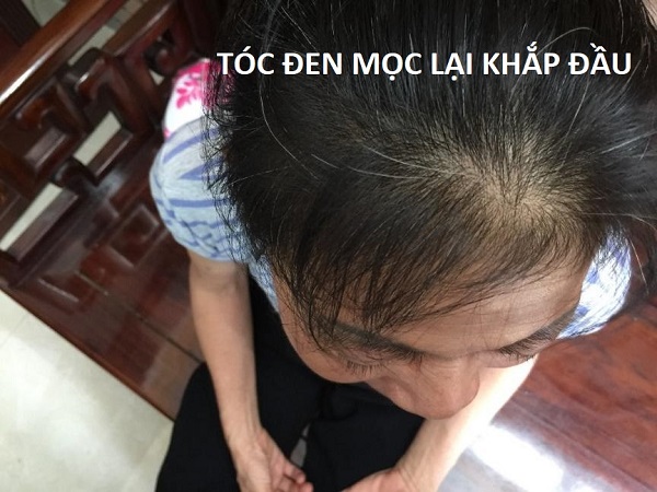 Dùng Maxxhair mỗi ngày 2 lần để giúp tóc mọc dày dặn 1