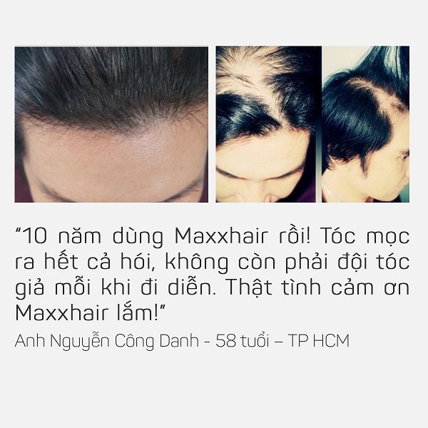 Có ai đã sử dụng Maxxhair đạt hiệu quả? 2