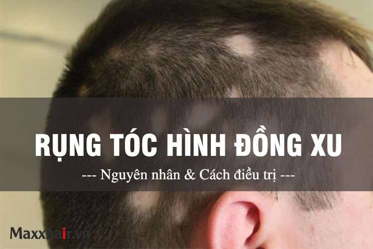 Rụng tóc hình đồng xu - Nguyên nhân và cách điều trị