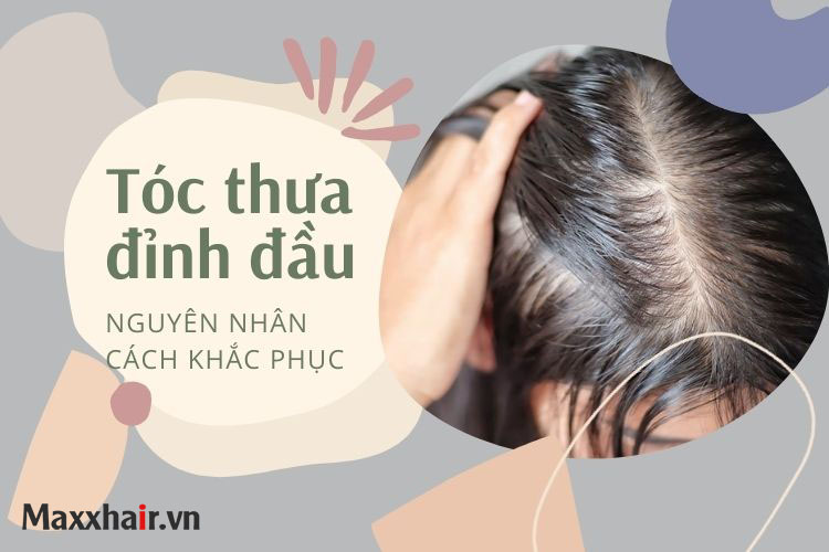 Tóc thưa và hói ở đỉnh đầu là do đâu? Khắc phục bằng cách nào?