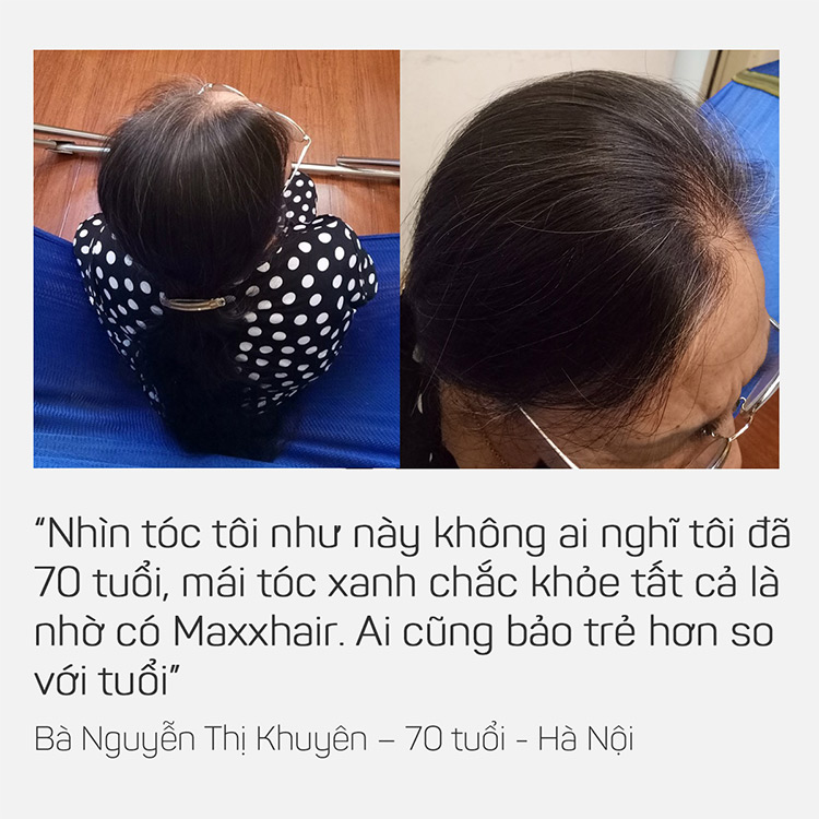 Có ai đã dùng Maxxhair hiệu quả chưa? 3