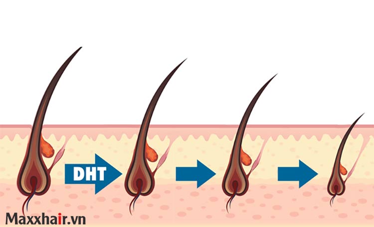 Nguyên nhân tăng DHT - Thủ phạm gây ra rụng tóc, hói đầu