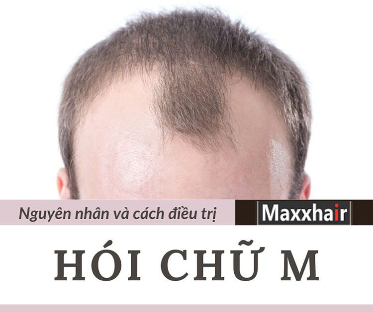 Hói chữ M: Biểu hiện, nguyên nhân và cách khắc phục