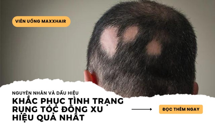 Rụng tóc đồng xu: Phương pháp giúp khắc phục hiệu quả nhất 